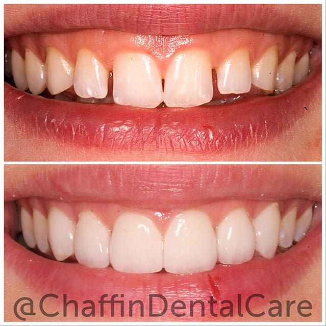 Before and after porcelain veneers smile transformation at Chaffin Dental Care