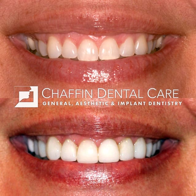 Before and after DURAthin porcelain veneers treatment at Chaffin Dental Care