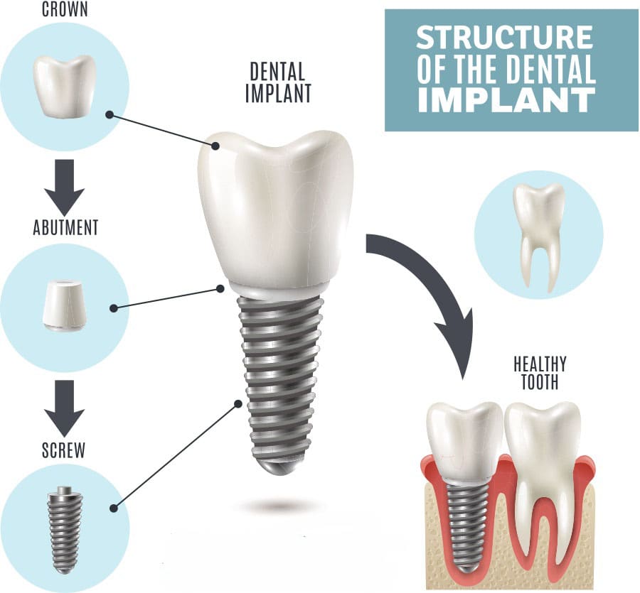 Structure of a dental implant